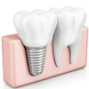 Airdrie Dentist, Dental Implants