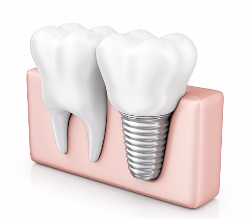 Dental Implants, Airdrie Dentist